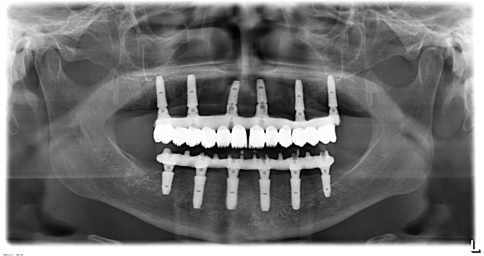 Radiografie panoramică după reabilitare completă: 6 implanturi la maxilar și 6 la mandibulă, cu lucrări fixe