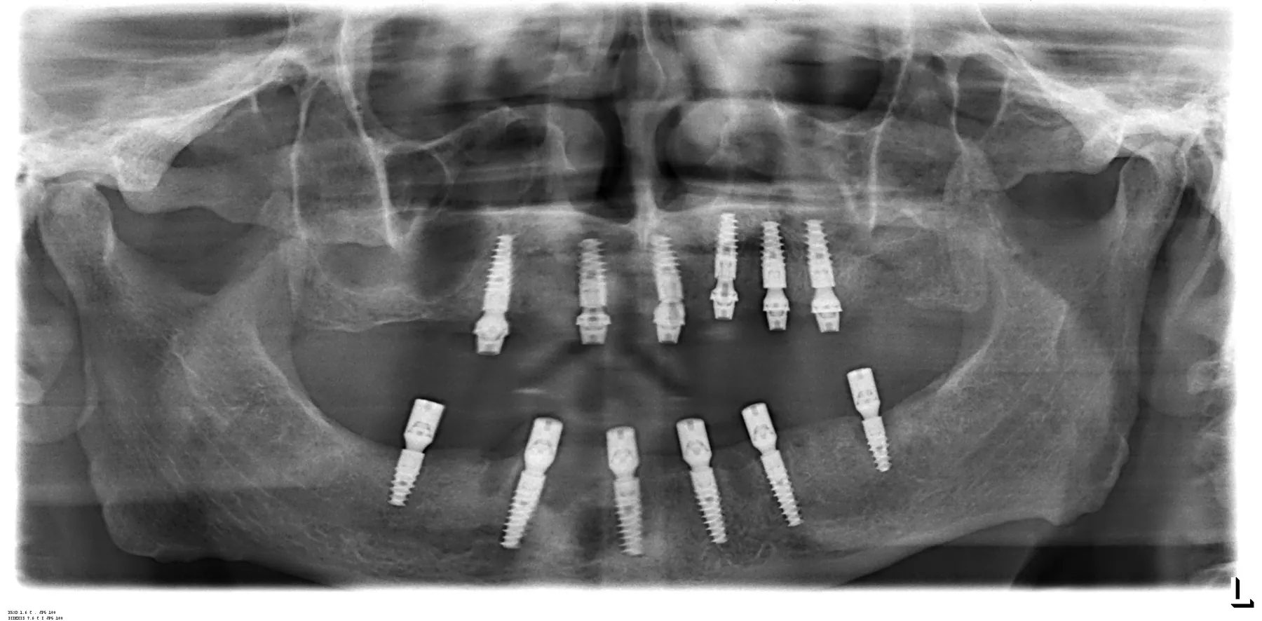 Radiografie panoramică: 6 implanturi la maxilar și 6 la mandibulă