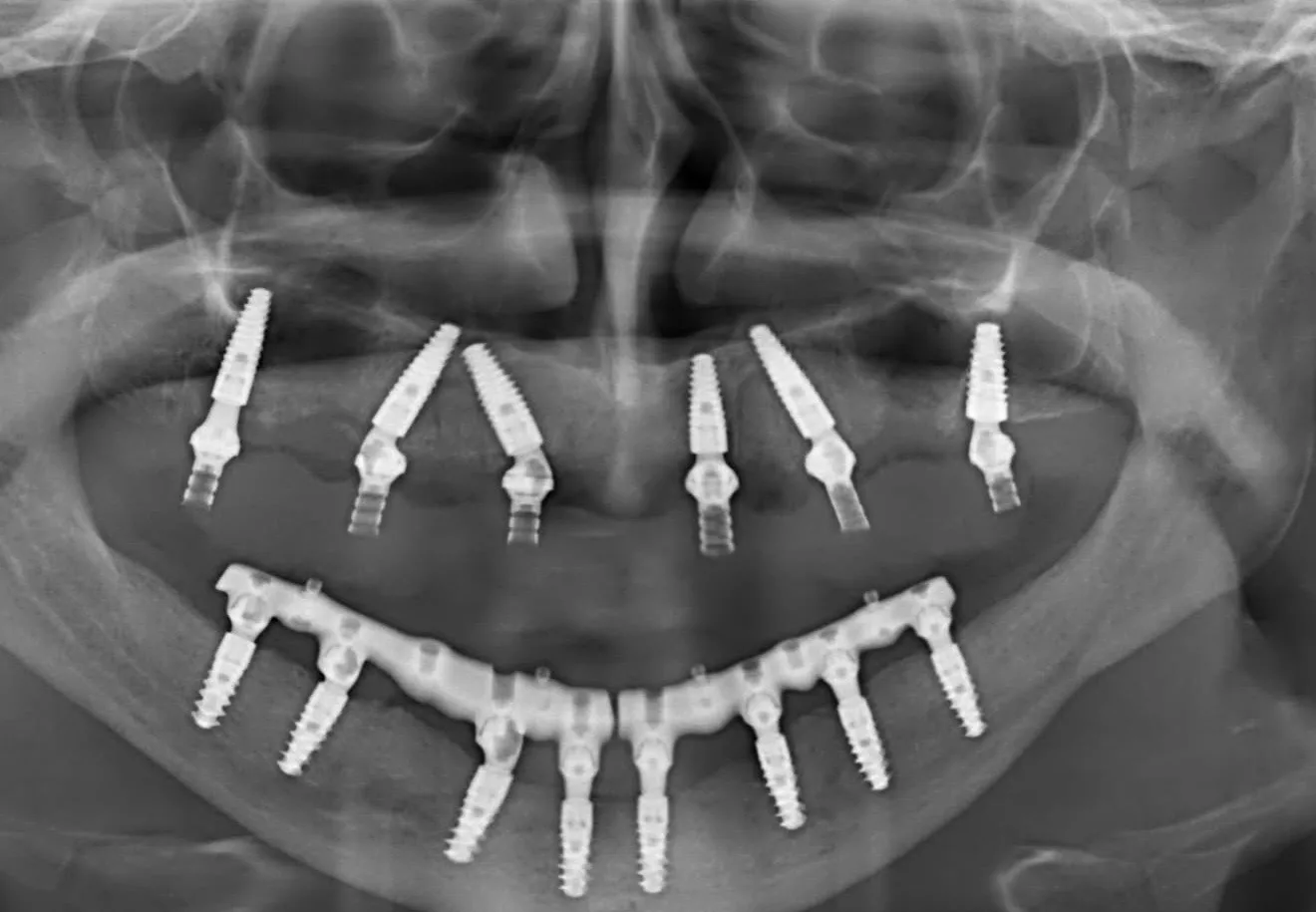 Radiografie: 6 implanturi la maxilar și 8 la mandibulă, cu bara de stabilizare
