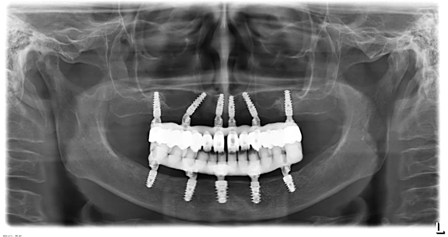 Radiografie panoramică: 11 implanturi Straumann BLX