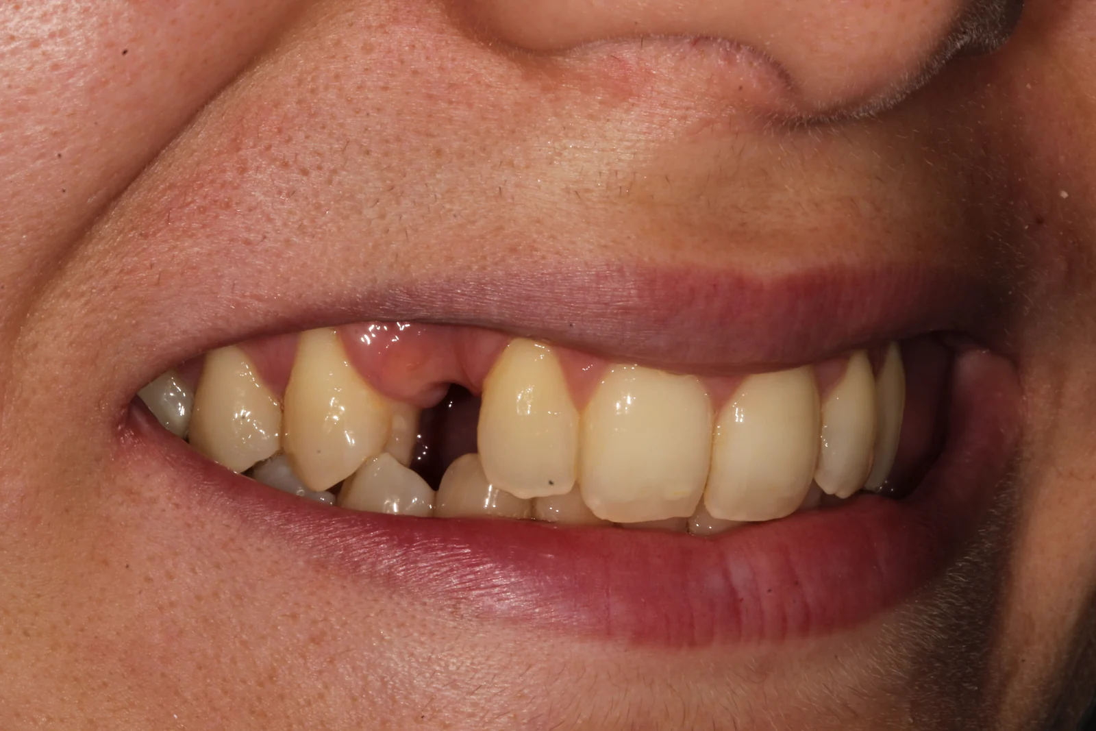 Pacient cu un dinte lipsă în zona frontală superioară, înainte de tratamentul cu implant dentar