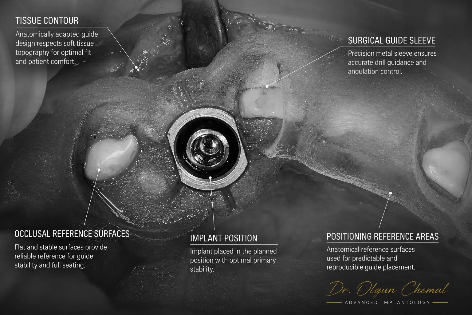 Implant dentar inserat prin ghidul chirurgical, în poziția planificată