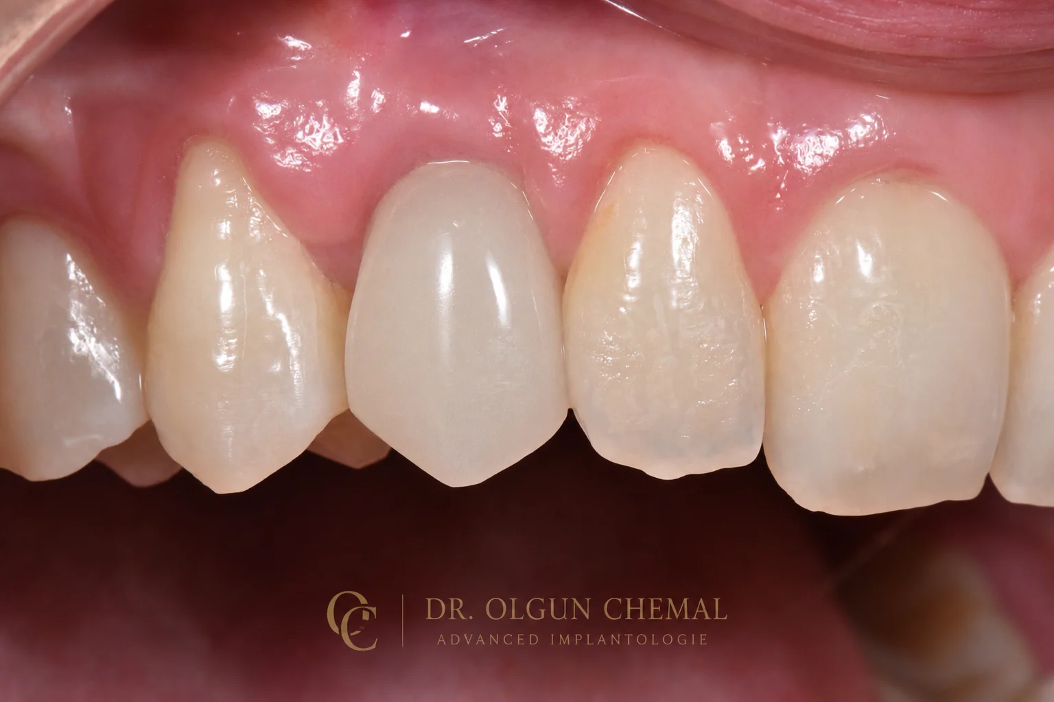 Coroană pe implant dentar în zona frontală superioară, integrată în arcadă — rezultat final