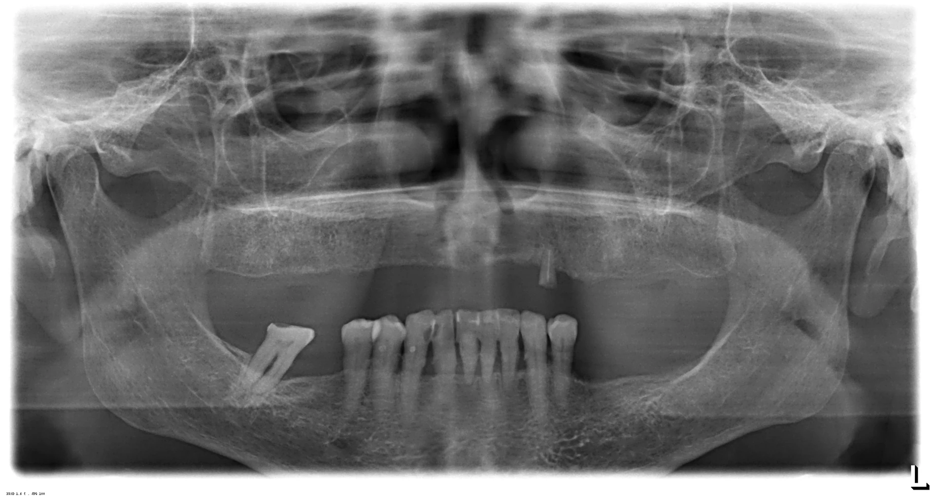 Radiografie panoramică inițială: maxilar edentat și dinți mandibulari cu pierdere osoasă avansată