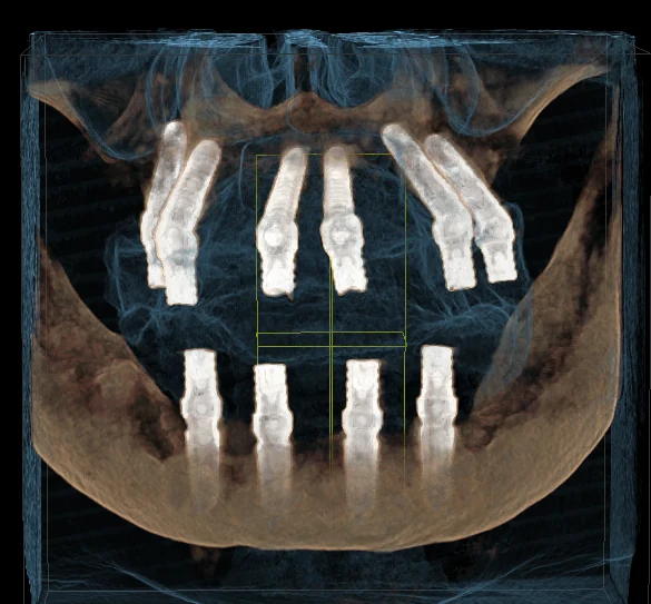 Reconstrucție 3D CBCT, vedere frontală, implanturi pe ambele arcade