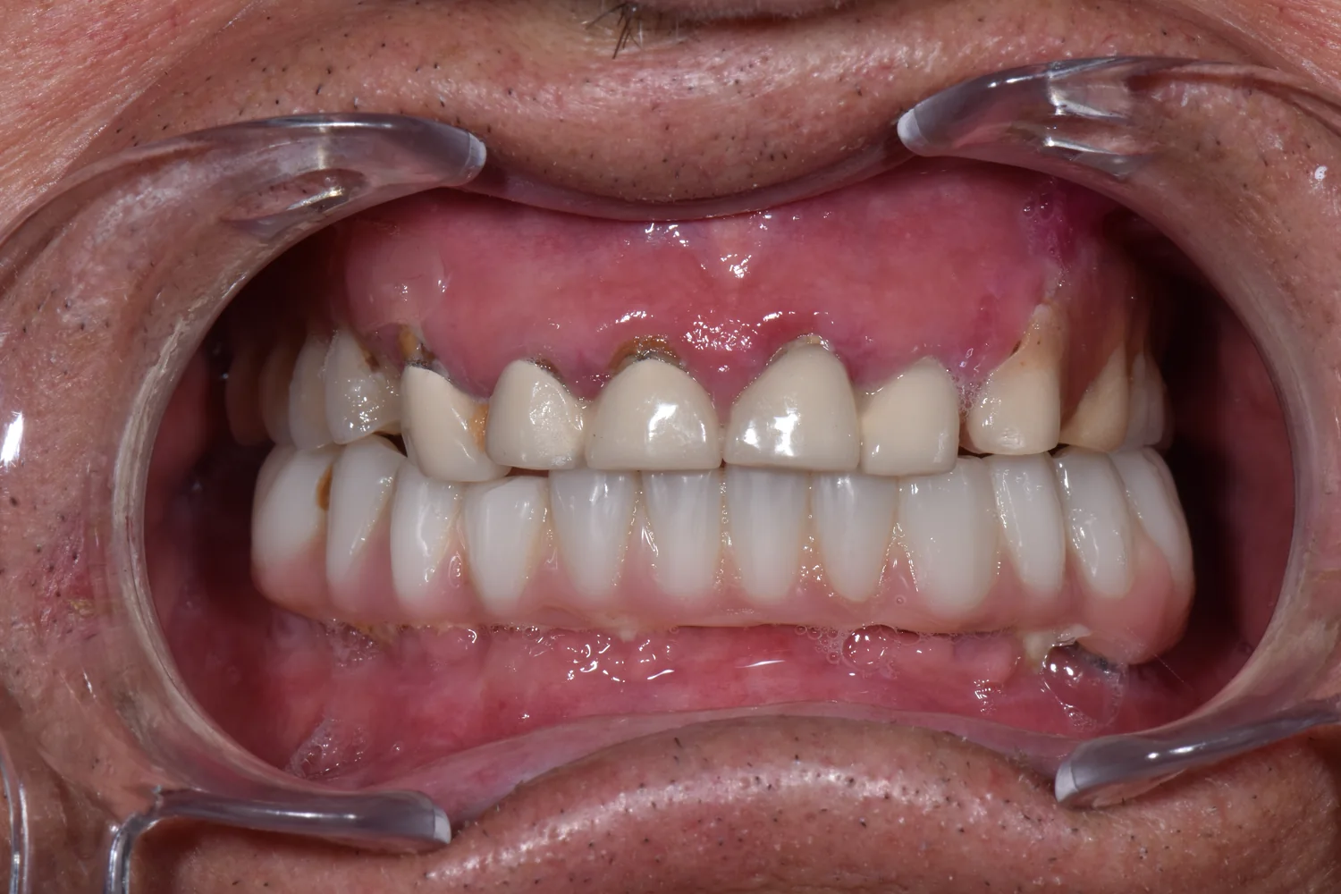 Aspect intraoral inițial: lucrări vechi și țesut inflamat pe arcada superioară