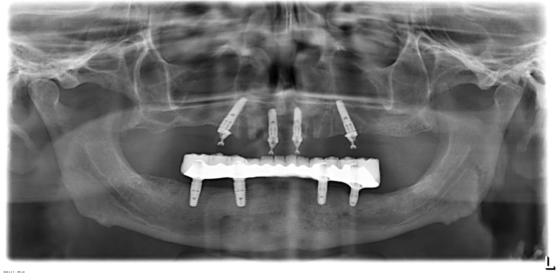 Radiografie panoramică: patru implanturi pe maxilar, cu cele posterioare înclinate, și lucrare fixă pe implanturi la mandibulă