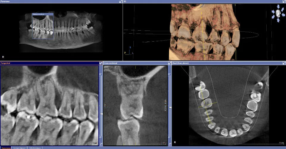 Tomografie CBCT, cadranul 1: molarul superior drept 1.6 sever afectat parodontal, cu resorbție osoasă pe fața dinspre obraz și dinspre palat