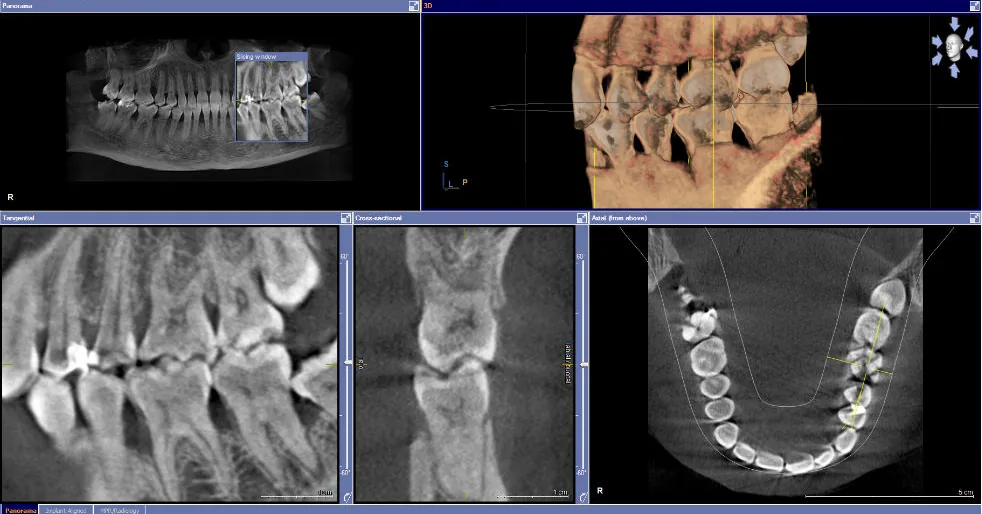 Tomografie CBCT, cadranul 3: molarii inferiori stângi afectați parodontal, cu pungi parodontale