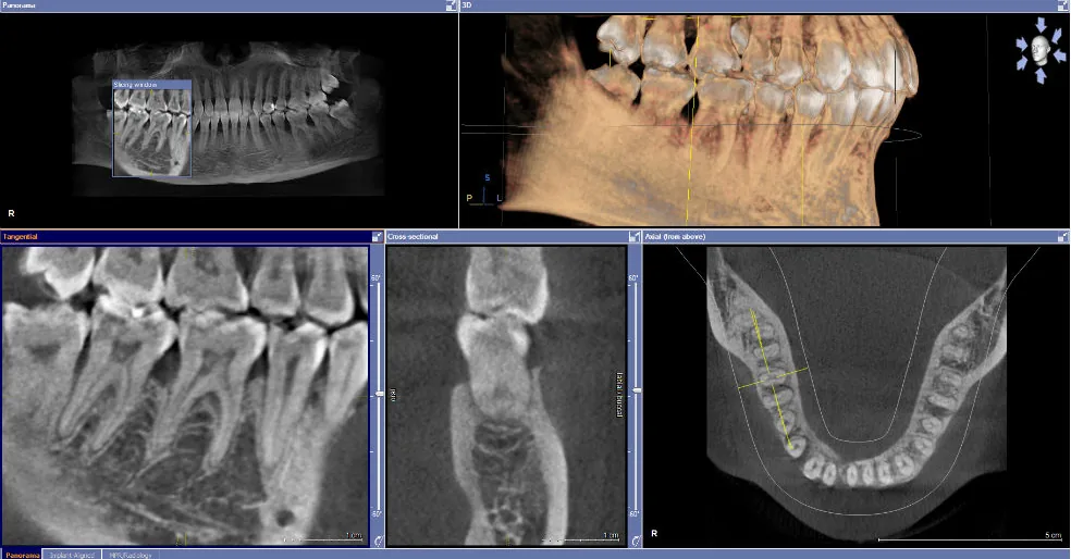 Tomografie CBCT, cadranul 4: molarul inferior drept 4.6 afectat parodontal, cu resorbție progresivă a osului alveolar