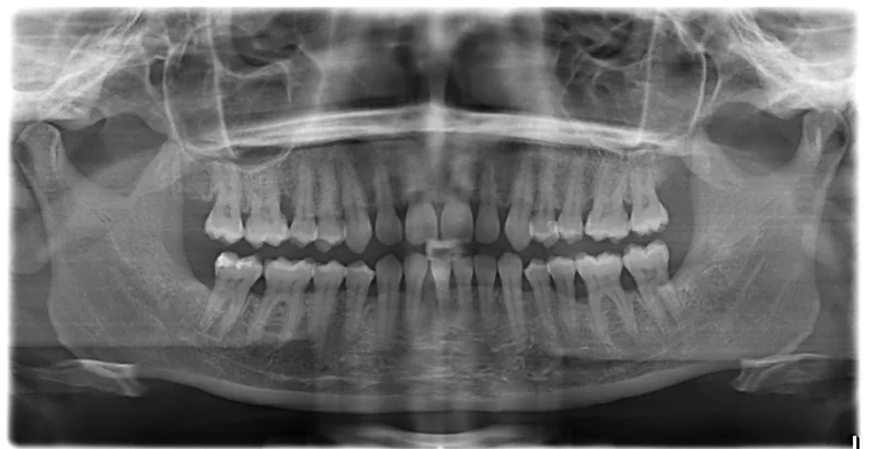 Radiografie panoramică de control, după extracția molarilor de minte și tratamentul parodontal