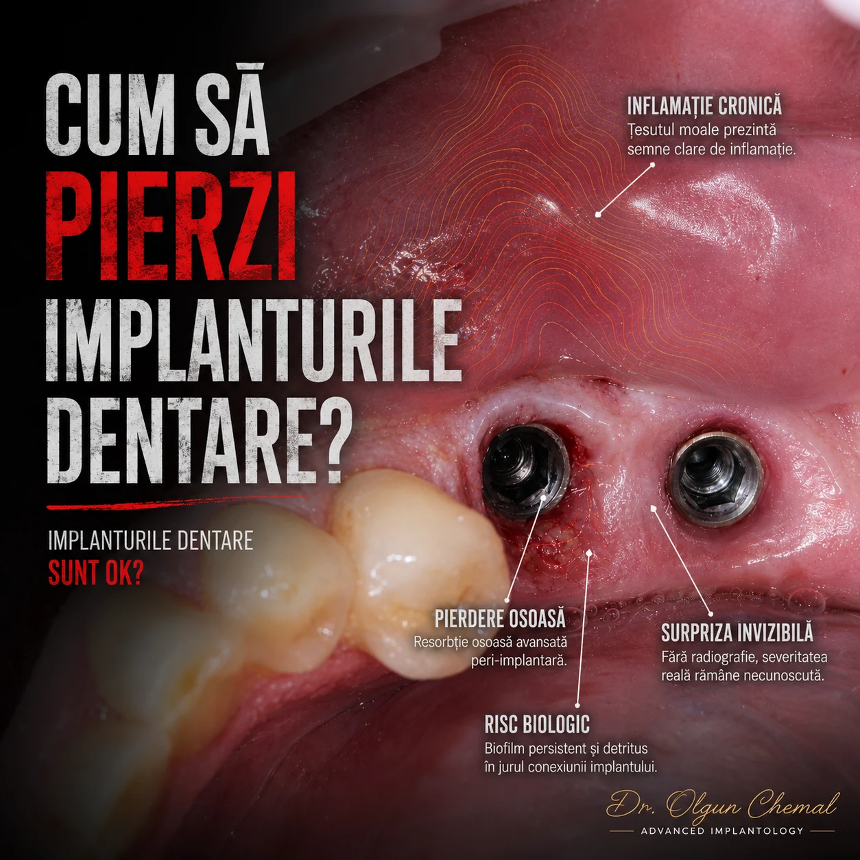 Periimplantită: inflamație cronică și pierdere osoasă în jurul implanturilor dentare