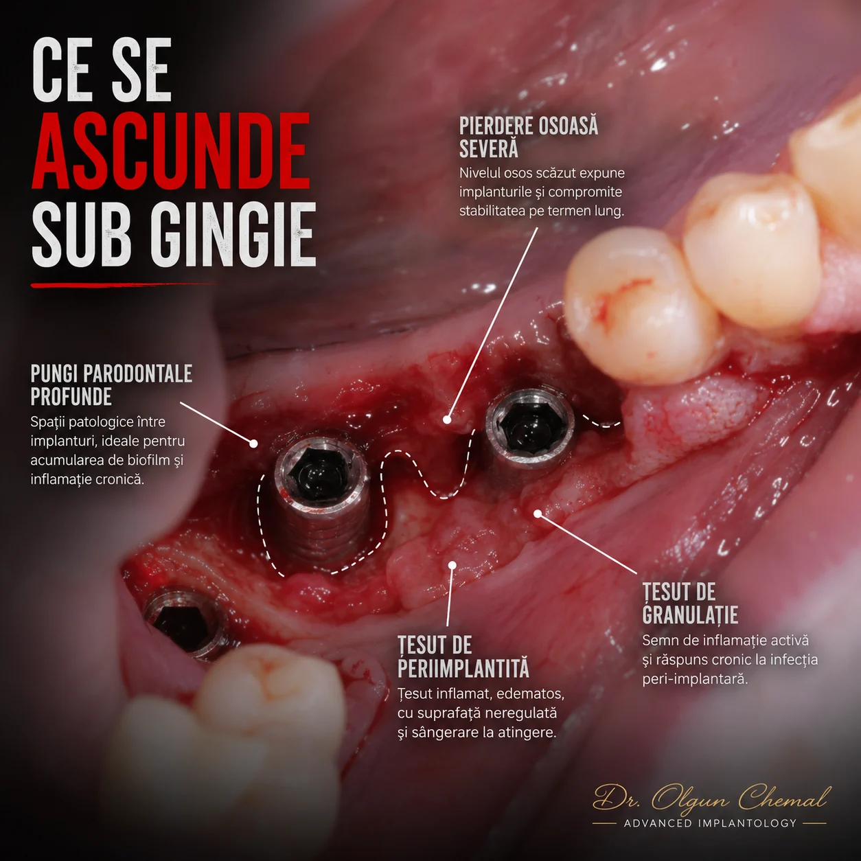 Ce se ascunde sub gingie: pungi profunde, pierdere osoasă severă și țesut de granulație în jurul implanturilor