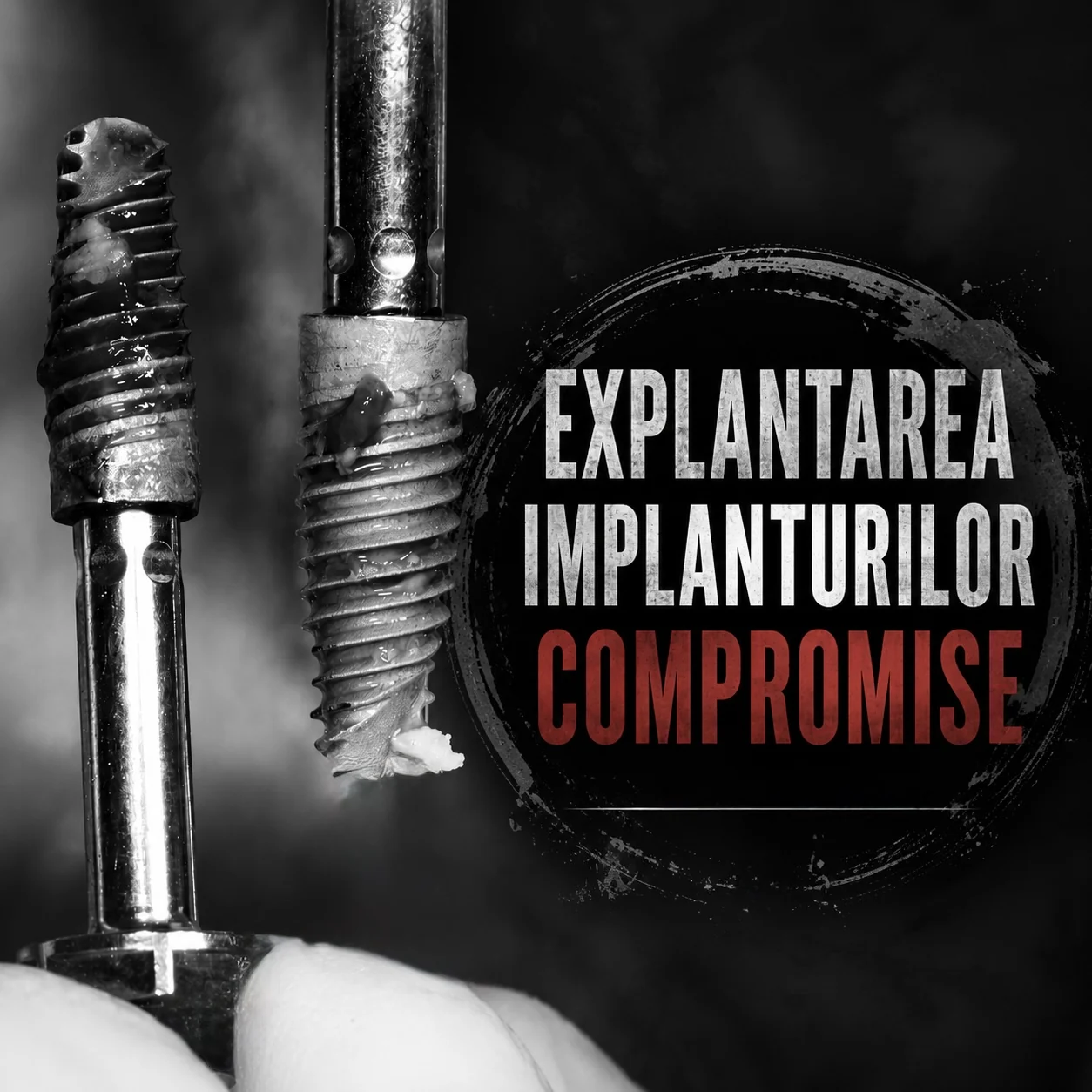 Explantarea implanturilor dentare compromise de periimplantită