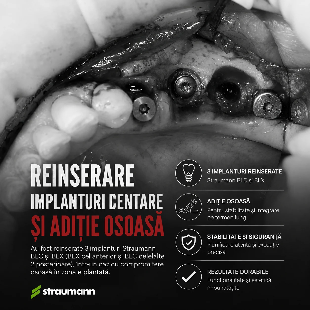 Reinserarea a trei implanturi dentare Straumann BLX și BLC după explantare, cu adiție osoasă