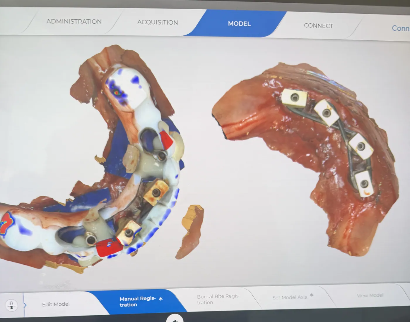 Modelul 3D al ambelor arcade, cu pozițiile implanturilor înregistrate