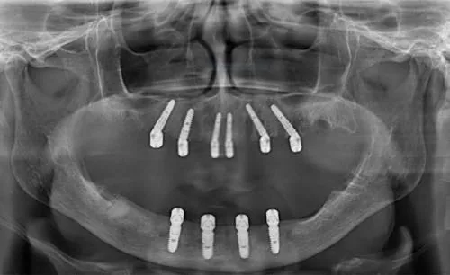 Radiografie panoramică cu implanturi dentare, caz 3