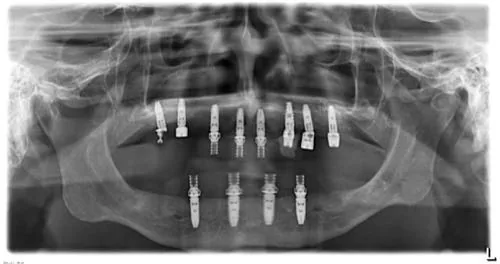 Radiografie panoramică cu implanturi dentare, caz 4