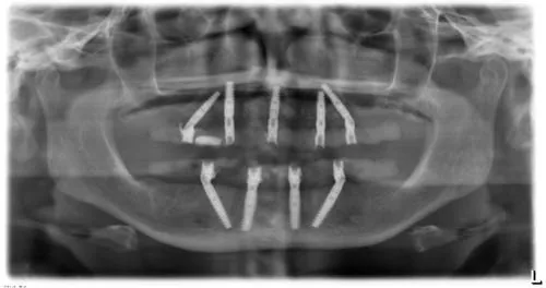 Radiografie panoramică cu implanturi dentare, caz 9