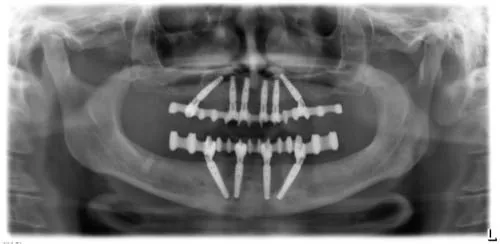 Radiografie panoramică cu implanturi dentare, caz 13