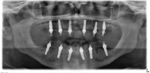 Radiografie panoramică cu implanturi dentare, caz 18