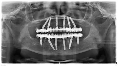 Radiografie panoramică cu implanturi dentare, caz 20