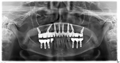Radiografie panoramică cu implanturi dentare, caz 23