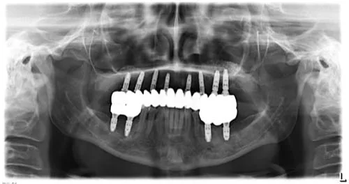 Radiografie panoramică cu implanturi dentare, caz 24