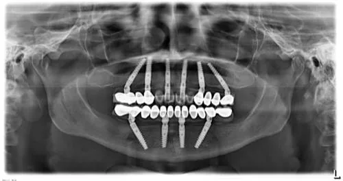 Radiografie panoramică cu implanturi dentare, caz 25