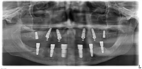 Radiografie panoramică cu implanturi dentare, caz 28