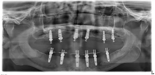 Radiografie panoramică cu implanturi dentare, caz 30