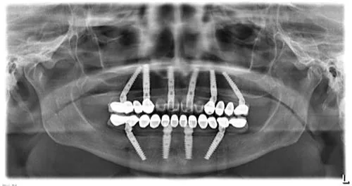 Radiografie panoramică cu implanturi dentare, caz 33