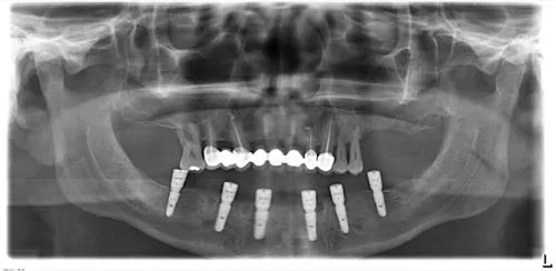 Radiografie panoramică cu implanturi dentare, caz 34