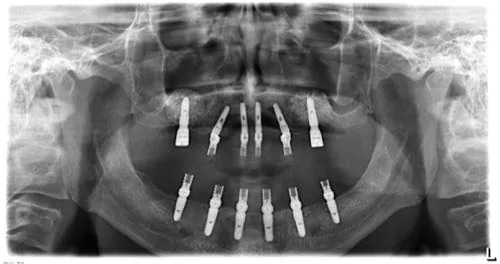 Radiografie panoramică cu implanturi dentare, caz 40
