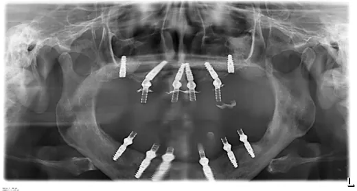 Radiografie panoramică cu implanturi dentare, caz 2