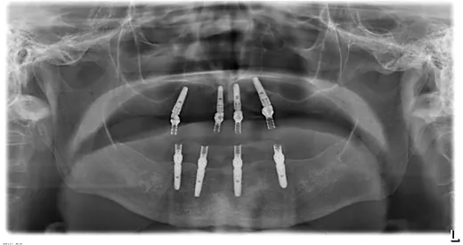 Radiografie panoramică cu implanturi dentare, caz 6