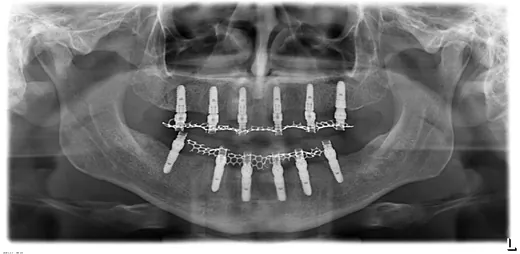 Radiografie panoramică cu implanturi dentare, caz 7
