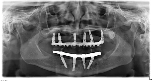 Radiografie panoramică cu implanturi dentare, caz 12