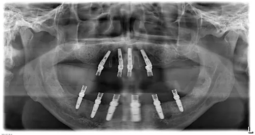 Radiografie panoramică cu implanturi dentare, caz 16