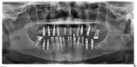 Radiografie panoramică cu implanturi dentare, caz 26
