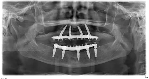 Radiografie panoramică cu implanturi dentare, caz 27