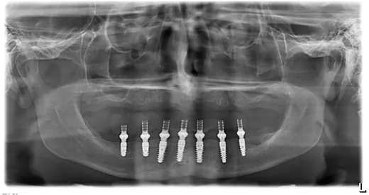 Radiografie panoramică cu implanturi dentare, caz 37