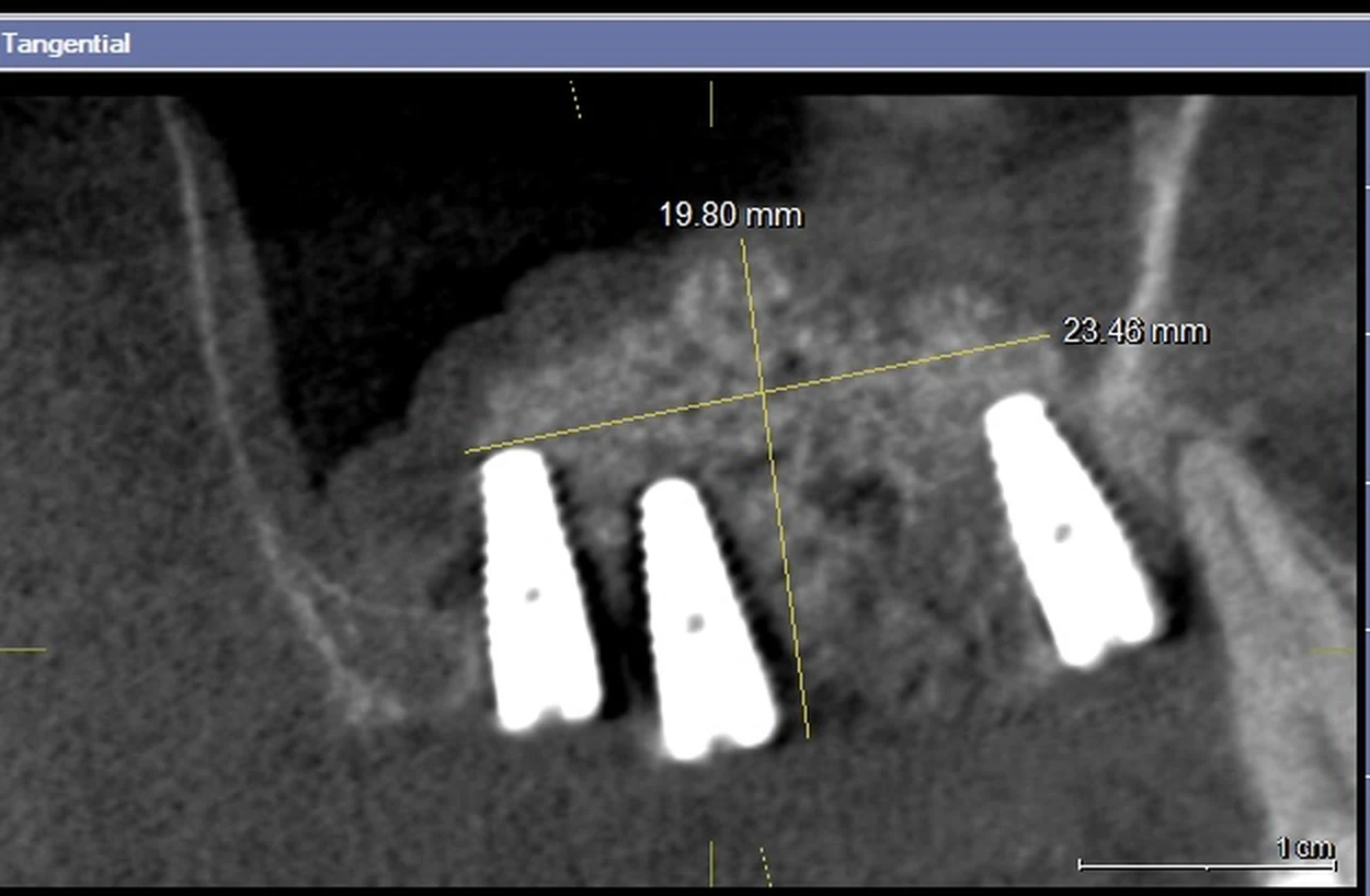 Control CBCT după sinus lift: volumul augmentat și poziția implanturilor